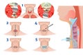 Upper and lower tracheostomy. Tracheal surgery.